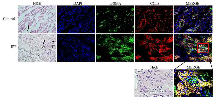 IPF 환자의 폐 조직에 CCL8 Immunofluorescence stain