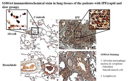 IPF 환자의 폐 조직에 S100A4 immunohistochemical stain