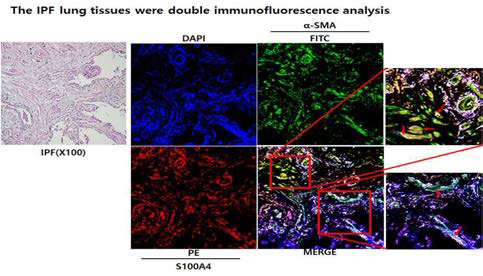 IPF 환자의 폐 조직에 S100A4 Immunofluorescence stain