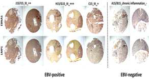 Immunohistochemistry of LMP1 and EBNA1 in EBV-positive NPC human tissues