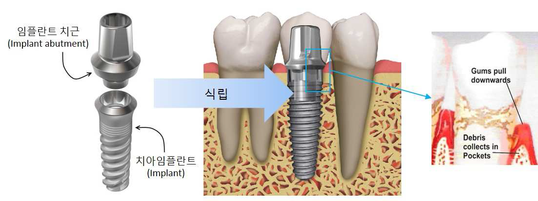 식립된 임플란트의 모식도 및 치주염의 일반적 양상