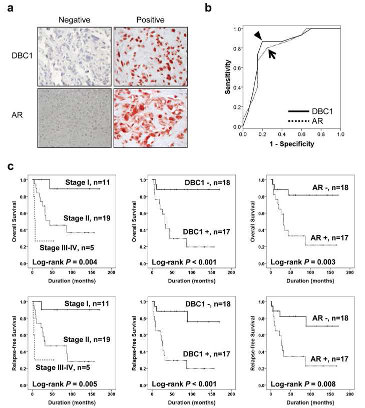 골육종 조직에서 DBC1과 AR에 대한 면역조직화학적 염색을 시행한 결과 DBC1은 주로 세포 핵에서 염색되었고, (a)세포 핵 및 세포질에서 염색됨. (b) ROC curve에 의한 면역조직화학적 염색에 대한 통계학적 분석을 시행함. (c) overall survival 과 relapse free survival에서 DBC1 및 AR 양성을 보인 경우 매우 불량한 결과를 초래함.