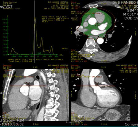 Decreased MDCT