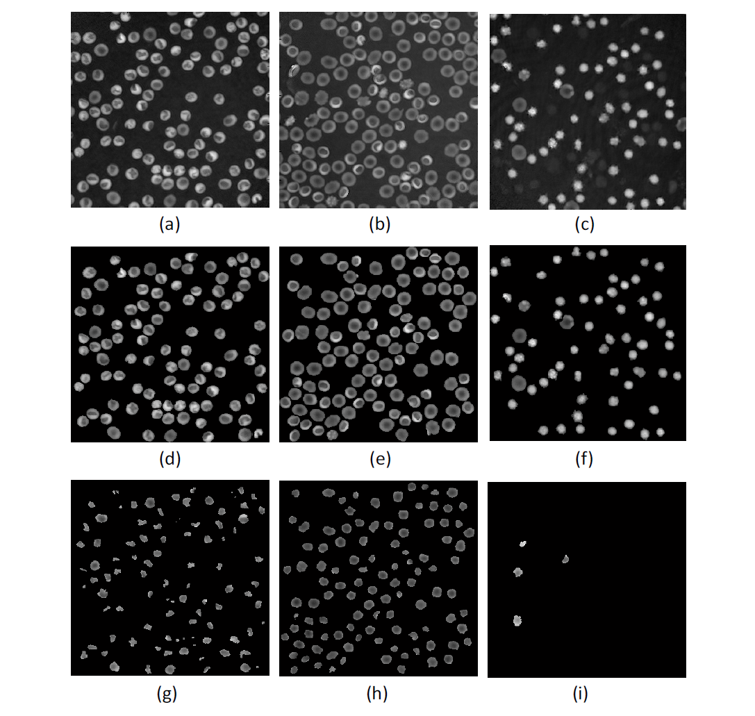 Reconstructed RBC phase images and their segmented phase images (a), (b), and (c) are reconstructed phase images for predominantly stomatocyte, discocyte, and echinocyte shape RBCs, respectively (d), (e), and (f) are the corresponding segmented phase images from (a), (b), and (c) (g), (h), and (i) are the segmented inner part of the RBCs in (a), (b), and (c)