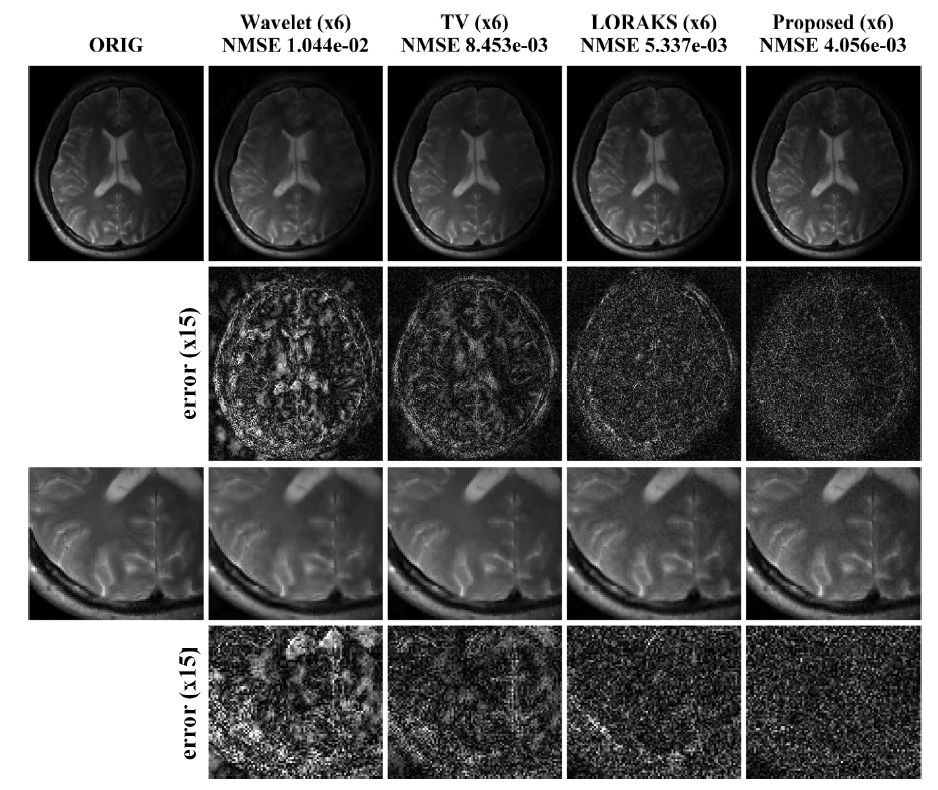 Single channel coil로 데이터를 얻은 경우, down-sampling rate가 6일 때, - wavelet 압 축 센싱, TV 압축 센싱, LORAKS, ALOHA로 복원한 결과이다. Error는 복원한 이미지와 원본 이미 지의 차이를 15배 확대한 것이다