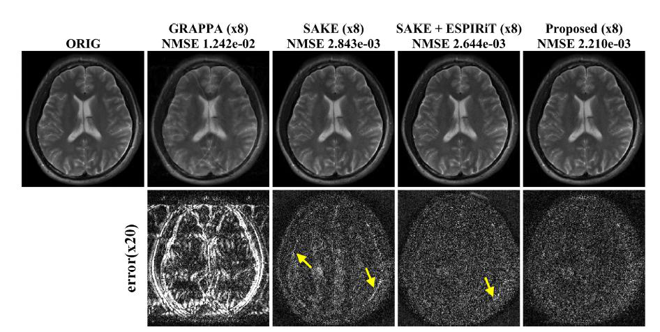 8배 acceleration된 parallel imaging을 GRAPPA, SAKE, SAKE와 EXPIRiT, ALOHA로 복원 한 이미지이다. 두 번째 줄은 원본 이미지와 복원 이미지의 차이를 20배 한 것이다. 노란색 화살표는 systematic artifact를 가리킨다