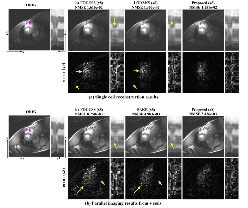 8배 다운 샘플링 된 k-space로부터의 복원 결과, (a) single coil (b) 4 coil, 보라색 선은 시간축 방향으로 확대된 y-t 단면이다, (a)와 (b)의 두 번째 줄은 복원 결과와 원본 이미지의 차이를 나타낸 것이다