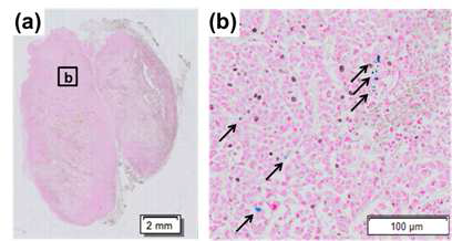 종양 조직의 철염색 이 미지, 화살표는 조직 내 자성 체를 의미함