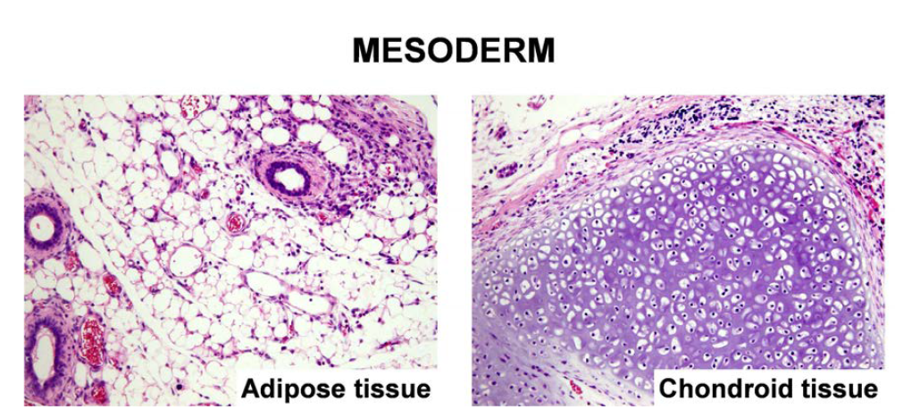 정상 역분화줄기세포로부터 형성된 teratoma - mesoderm 계열