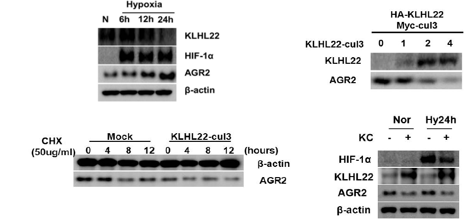 저산소 환경에서 AGR2의 발현 조절자 발굴 및 발현 수준 검증