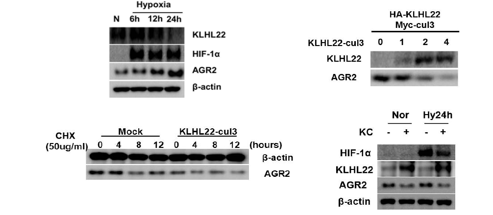 저산소 환경에서 AGR2의 발현 조절자 발굴 및 발현 수준 검증