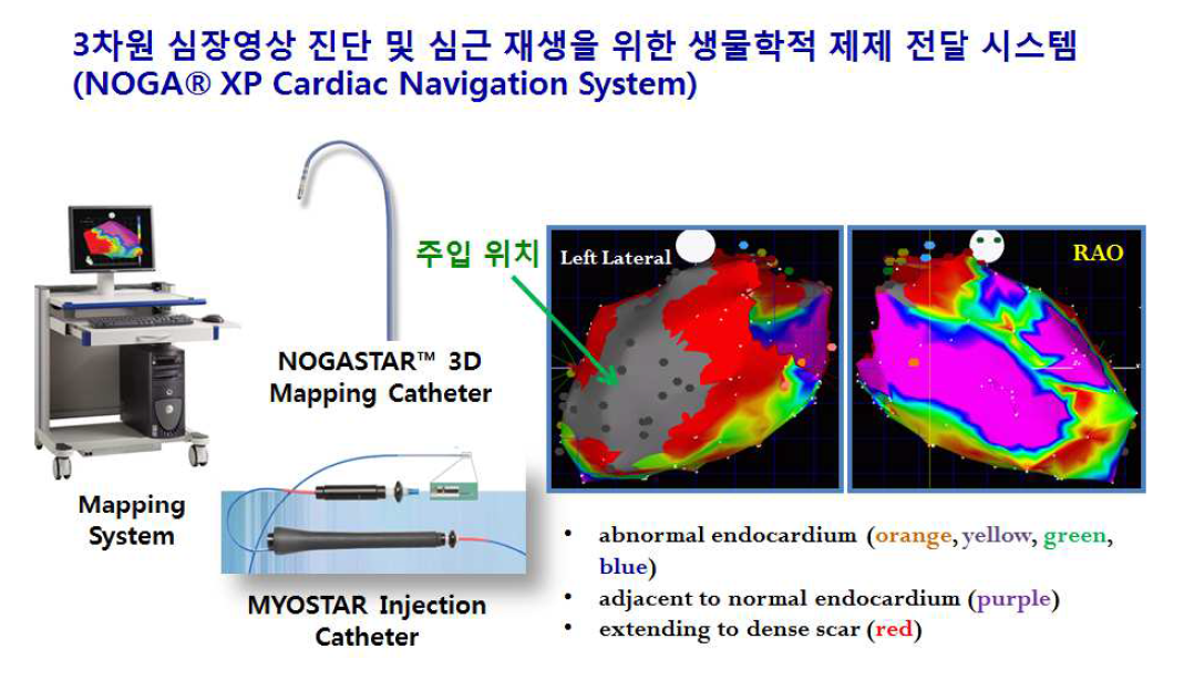 NOGA 시스템의 구성과 심장매핑으로 이식 위치를 정확하게 지정