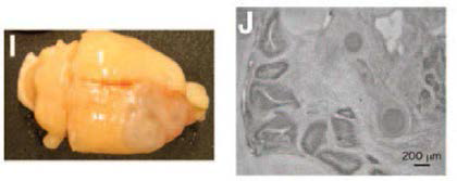 분화된 사람배아줄기세포 유래 도파민 신경세포 이식 후 이식 부위(왼쪽)와 조직 구조상(오른쪽) 종양 발생.