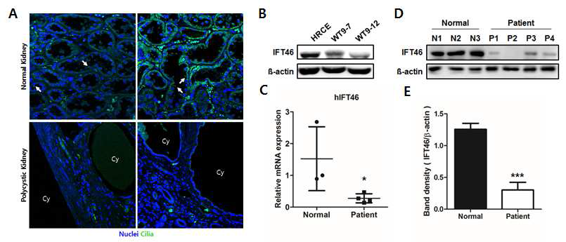 다낭신 환자 조직에서 섬모 표현형 관찰 및 IFT46 발현 패턴 검증