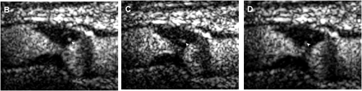 조영증강 초음파로 촬영한 경동맥 동맥경화반내의 신생혈관을 촬영 한 사진.