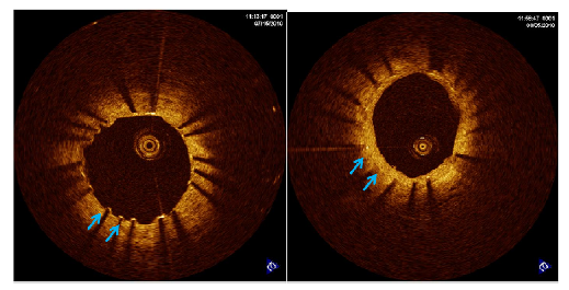 관동맥 스텐트 시술 직후(좌)와 3 개월 후 재내피재생화가 이루어진 모습 (우)