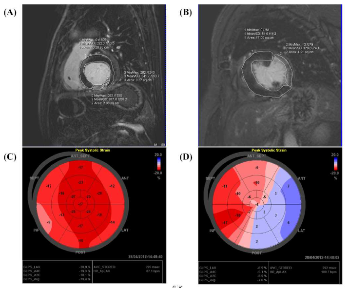 심장 MRI 와 조영증강 심초음파 사진.