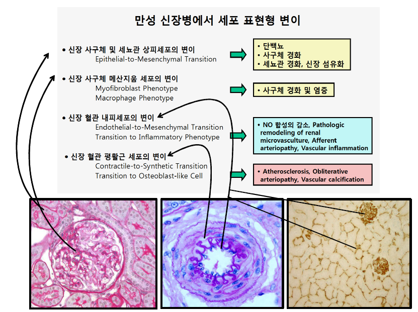 만성신장병에서 세포 표현형 변이의 spectrum 및 의의: 가설