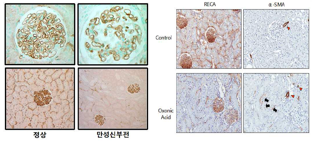 만성 신장병에서 신장의 Endo-MT