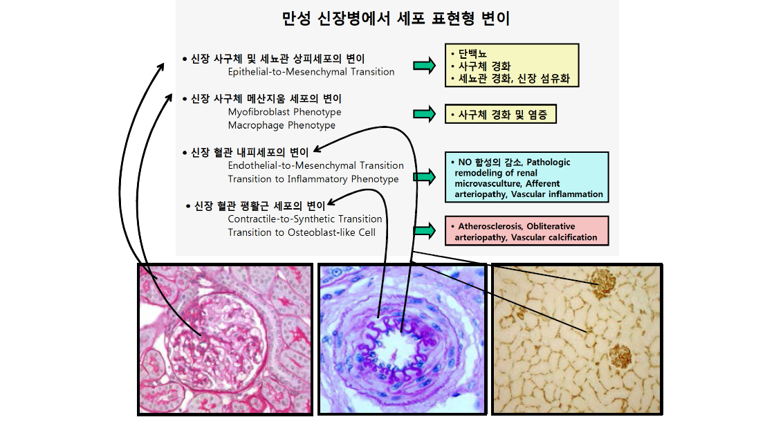 만성신장병에서 세포 표현형 변이의 spectrum 및 의의: 가설 (I)