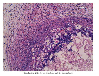 PMMA 고분자물질이 있는 쪽에 Neutrophil과 같은 과립세포들과 죽은 세포들이 보 이고, 그 주변으로 foamy macrophages가 모여있고 그 밖으로 fibroblast로 이루어진 치밀한 섬유소성결 합조직이 둘러싸고 있음.