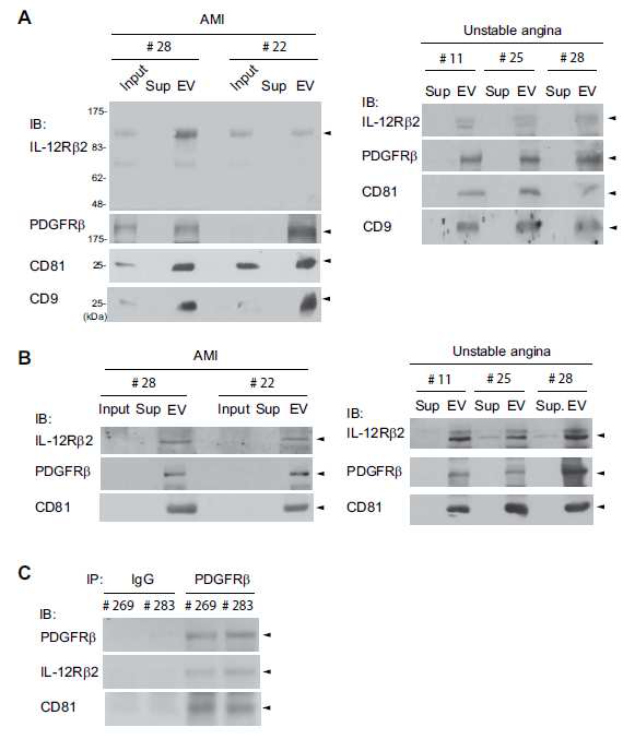 A,B. 심근경색 진행 상태에 따른 환자군 혈청 exosome내의 IL-12Rbeta2 발 현 확인. A는 초고속원심분리기를 이용한 분획,B는 Exosom 특이적 침전 키트를 이용 한 분획. C. PDGFR beta 면역침전물에 IL-12R beta2의 발현 확인. D. Native 혈청 단 백질내에서의 IL-12R beta2의 검출