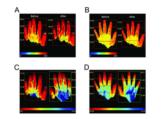 침술의 효과로 혈류가 개선됨을 보임. (A, B) 모두 침 놓기 전(좌)보다 후(우)에 손에서의 혈류가 증 가한 것을 볼 수 있음. (C, D)는 각각 A와 B의 Tmax map임.
