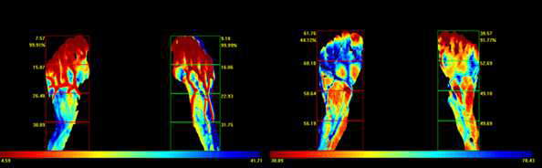 정상의 대표적 패턴의 Tmax 맵(좌)과 당뇨병성 혈관 합병증이 있는 환자군의 Tmax 맵(우)