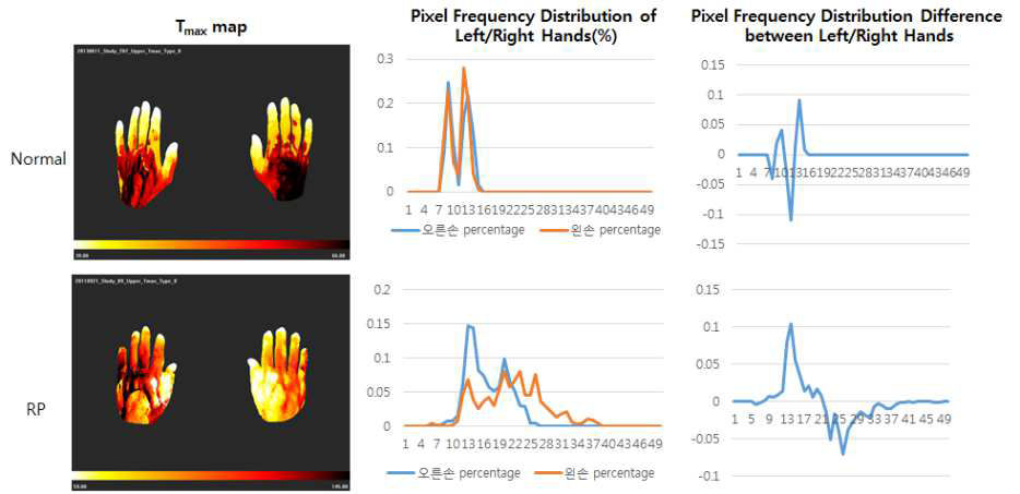 정상과 RP환자의 Tmax 맵의 비대칭성. 각 pixel의 Tmax를 보이는 맵(왼쪽), 양 손의 Tmax 값을 전체 pixel 개수 대비 각 도수에 속해있는 pixel의 퍼센티지를 히스토그 램으로 나타낸 도표(가운데), 히스토그램에서 한 쪽 손에서 다른 쪽 손의 값을 제한 그 래프(오른쪽)