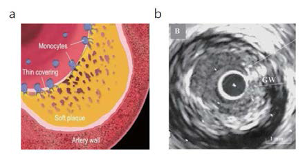 (a) 혈관벽 내 죽상의 성분 및 구 조, (b) 관상동맥 죽상병변의 IVUS 영상