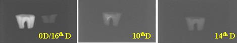 Confirmation of decalcified 3rd molar-root using X-ray radiation.