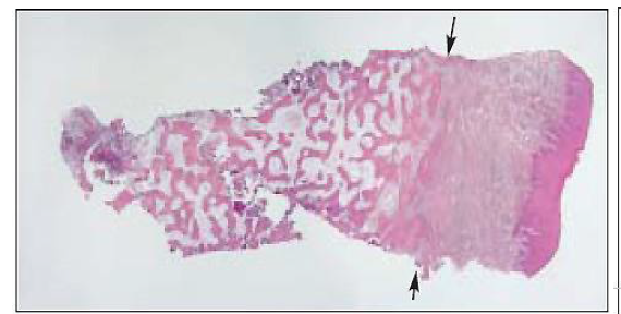 In this mature healing socket(16 weeks, disease group)the trabeculae are interconnected in a pattern