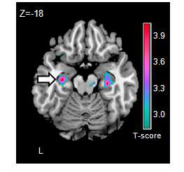 신경증적 성격과 비례하 여 활성화양의 저하를 보이는 두 뇌 영역