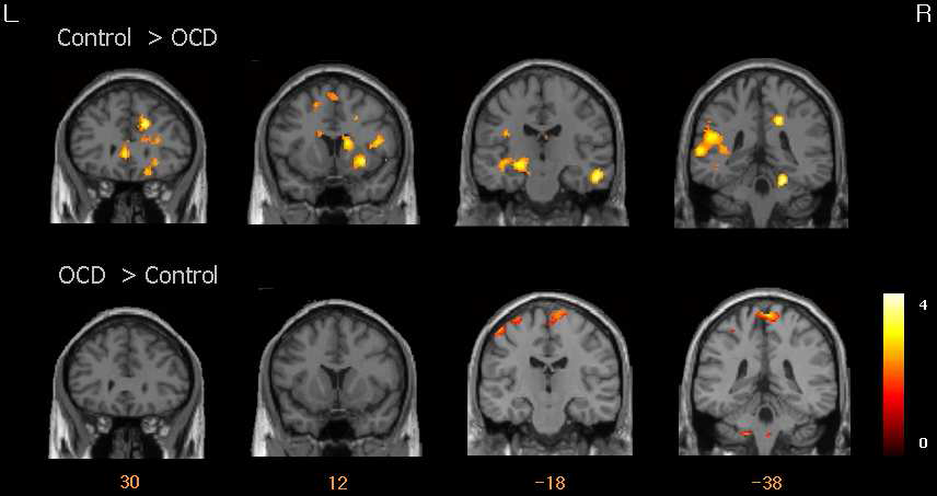 강박증 집단과 정상집단의 뇌활성 차이