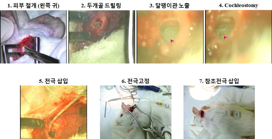 달팽이관 전극 삽입 수술 과정