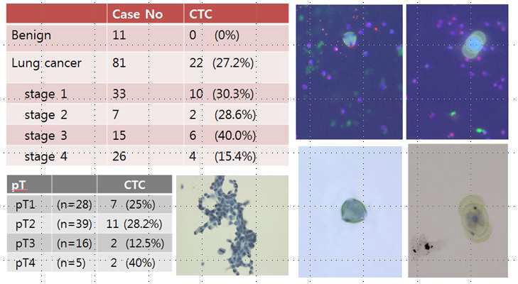 폐암환자군의 CTC 양성률 확인 결과 및 검출된 특이형태 CTC 영상