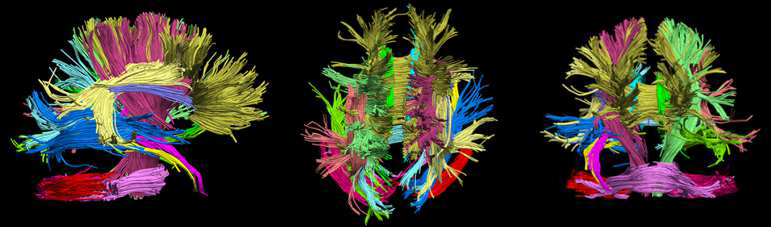 Diffusion spectral imaging (DSI)을 이용한 뇌의 백질 구조