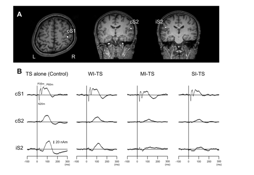 (A) The location of the ECDs for the left median nerve stimulus in the control condition. The ECDs were superimposed on the brain MRI of a representative subject. The ECD for early response was located in the posterior bank of the central sulcus, corresponding to S1, and the later responses were located in the upper bank of the lateral sulcus bilaterally, corresponding to S2. (B) The source strength waveforms of the ECDs obtained in each experimental condition for the same subject