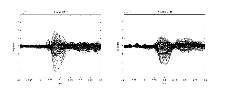 왼쪽. 오른손 엄지손가락 촉각 자극에 대한 contalateral 영역 response의 butterfly plot. 오른쪽. 오른손 엄지손가락 촉각 자극에 대한 ipsilateral 영역 responses