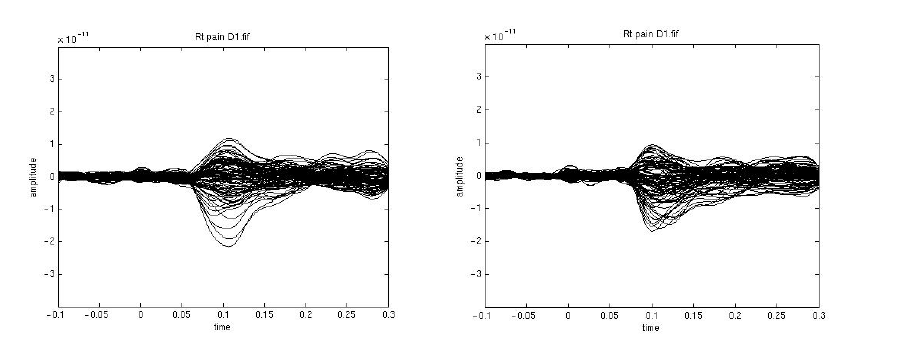 왼쪽. 오른손 엄지손가락 통각 자극에 대한 contalateral 영역 response의 butterfly plot. 오른쪽. 오른손 엄지손가락에 통각 자극에 대한 ipsilateral 영역 responses