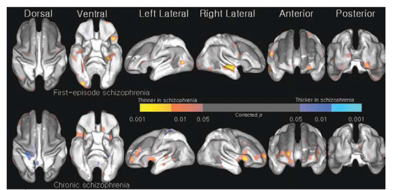 Statistical map of thinned cortical thickness: q map demonstrating cortical thinning of first-episode schizophrenia (top row), chronic schizophrenia (bottom row)