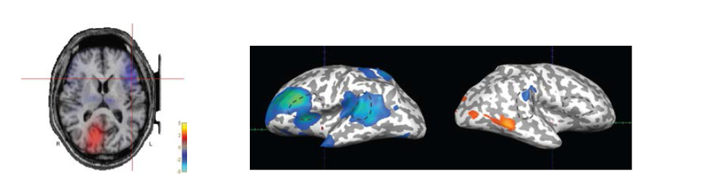 왼쪽. Spatial mapping of gamma ERD/ERS of a sample case using the beamformer approach. Gamma ERD was prominent in the left inferior frontal area (crossmark). 오른쪽. Gamma ERD/ERS of the inferior frontal and superior temporal ROIs of a sample case