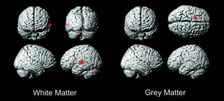 Deaf versus hearing white matter and gray matter VBM