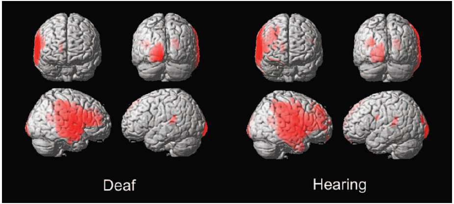 Asymmetry VBM of gray matter in deaf and hearing subjects