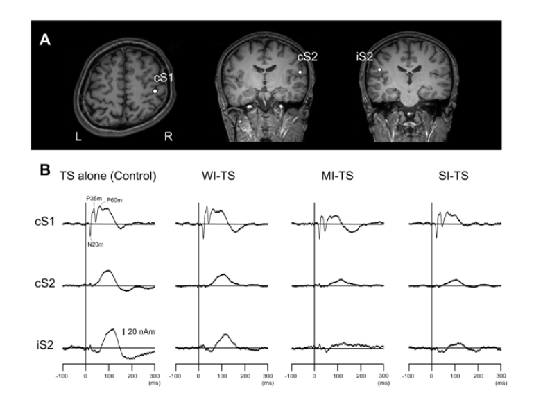 (A) The location of the ECDs for the left median nerve stimulus in the control condition. The ECDs were superimposed on the brain MRI of a representative subject. The ECD for early response was located in the posterior bank of the central sulcus, corresponding to S1, and the later responses were located in the upper bank of the lateral sulcus bilaterally, corresponding to S2. (B) The source strength waveforms of the ECDs obtained in each experimental condition for the same subject. The vertical line indicates the stimulus onset.