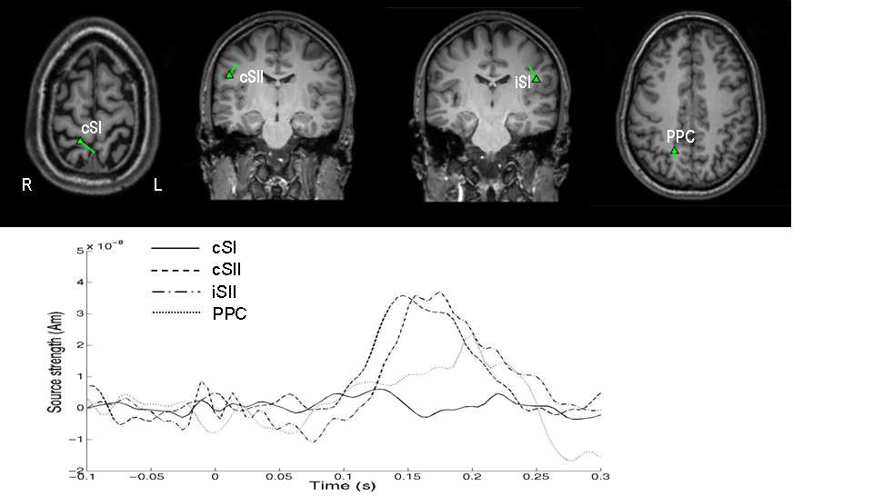 위. 통각 자극시 각 신호원의 위치를 피험자의 MRI에 매핑. 아래. 각 신호원의 시간축에서 활성화 비교.