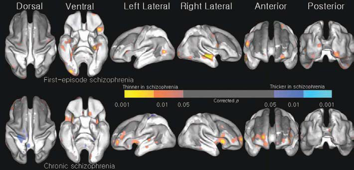 Statistical map of thinned cortical thickness: q map demonstrating cortical thinning of first-episode schizophrenia (top row), chronic schizophrenia (bottom row).