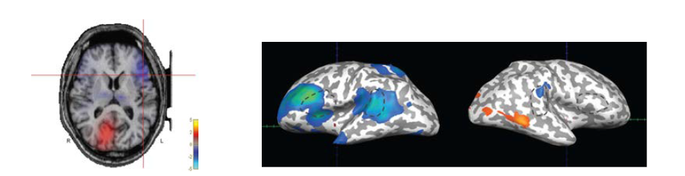 왼쪽. Spatial mapping of gamma ERD/ERS of a sample case using the beamformer approach. Gamma ERD was prominent in the left inferior frontal area (crossmark). 오른쪽. Gamma ERD/ERS of the inferior frontal and superior temporal ROIs of a sample case.