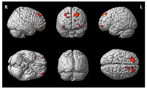 Rendered brain map showing the regions inversely correlated with BDHI agression total score (P <0.005 uncorrected, k=30voxels).