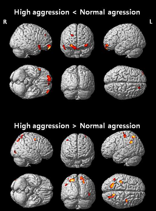 Areas showing decreased activation in participants with high aggression level compared to participants with normal aggression level (P < 0.005 uncorrected, k=30).